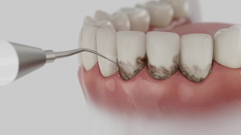 Reliable Dental Implants contractor in Clearfield, PA by Smile Center Dentistry